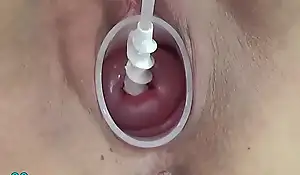 Milf cervix wraparound close to spiral catheter for insemination and vibrator jav extreme